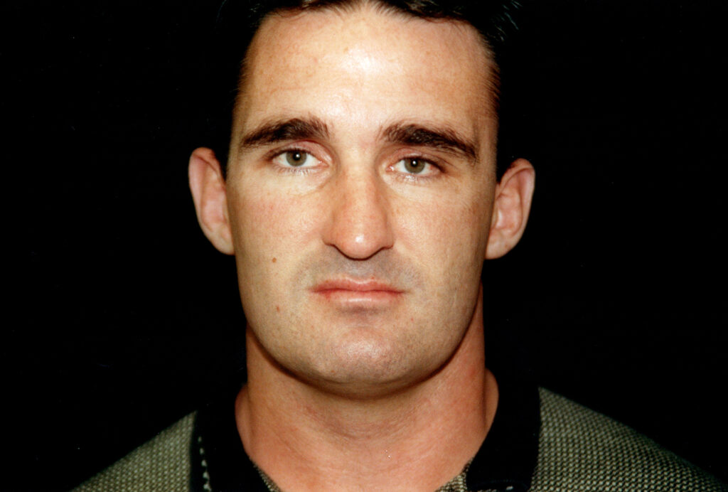 Before Image: Rhinoplasty - front