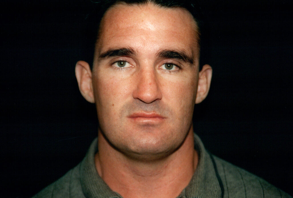 After Image: Rhinoplasty - front