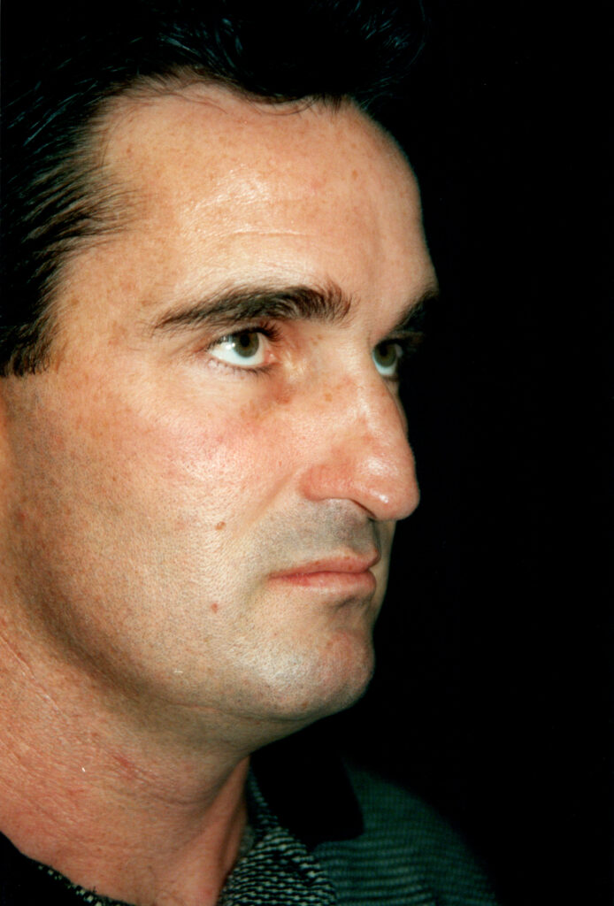 Before Image: Rhinoplasty - right-front-oblique