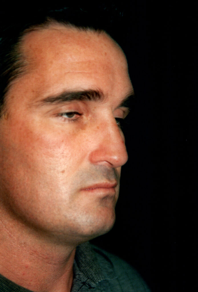After Image: Rhinoplasty - right-front-oblique