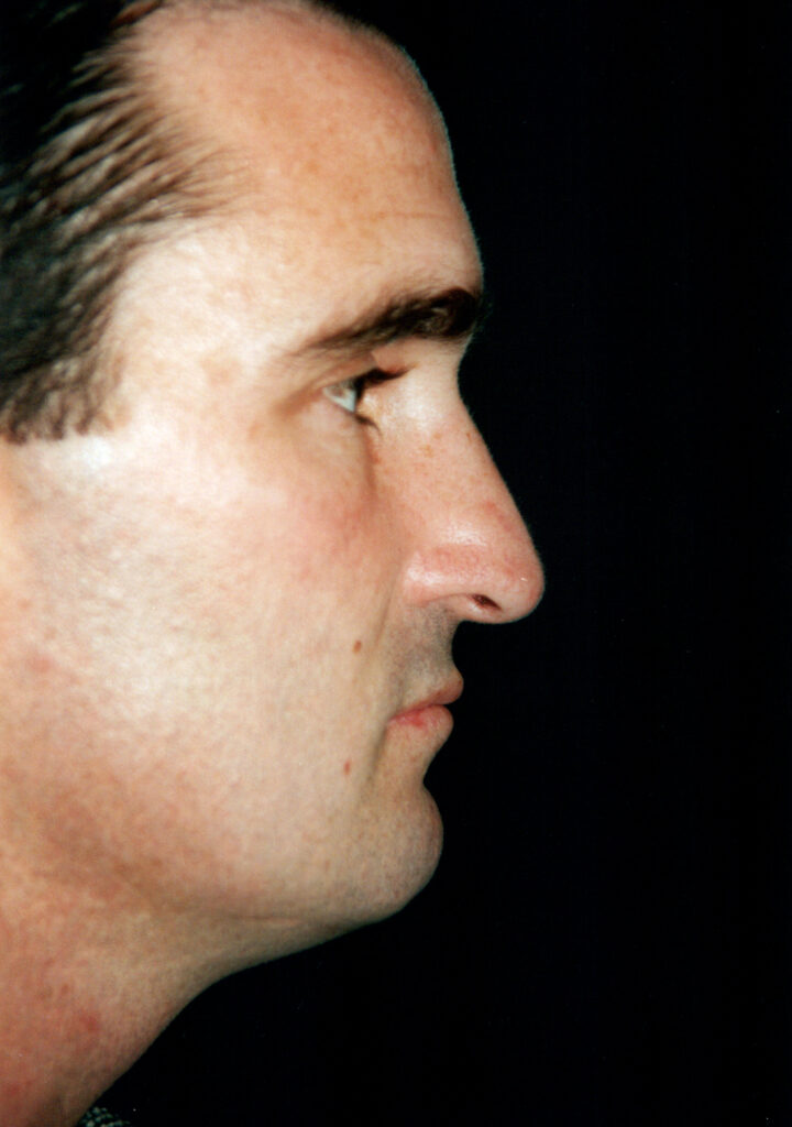 Before Image: Rhinoplasty - right-side