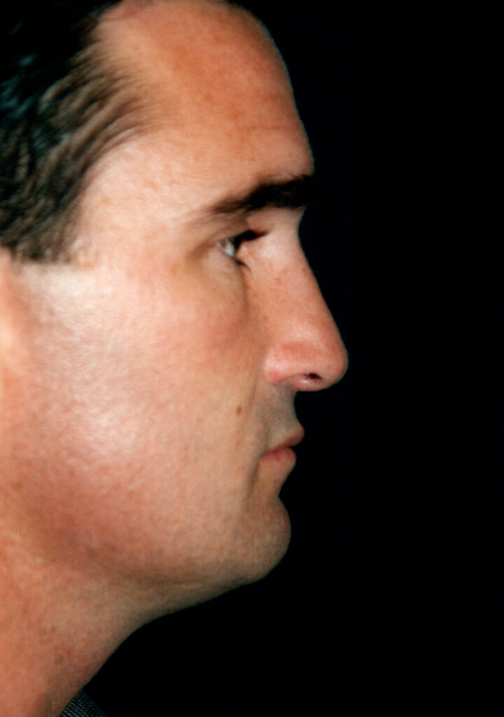 After Image: Rhinoplasty - right-side