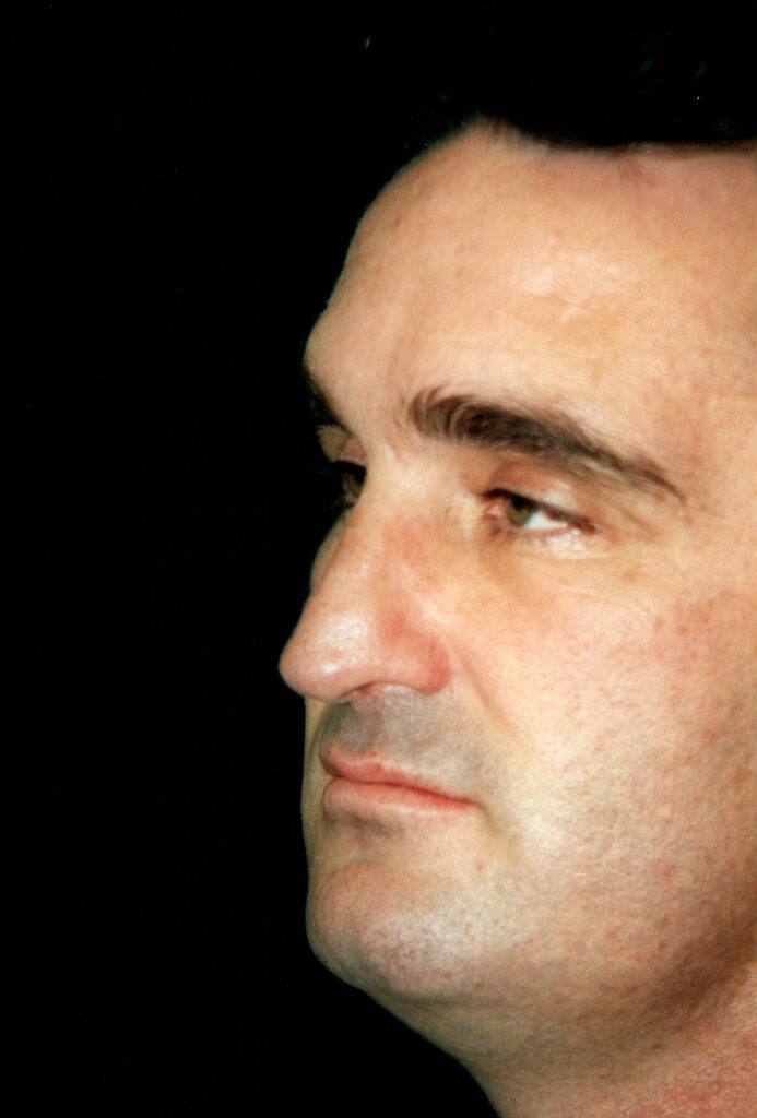 Before Image: Rhinoplasty - left-front-oblique
