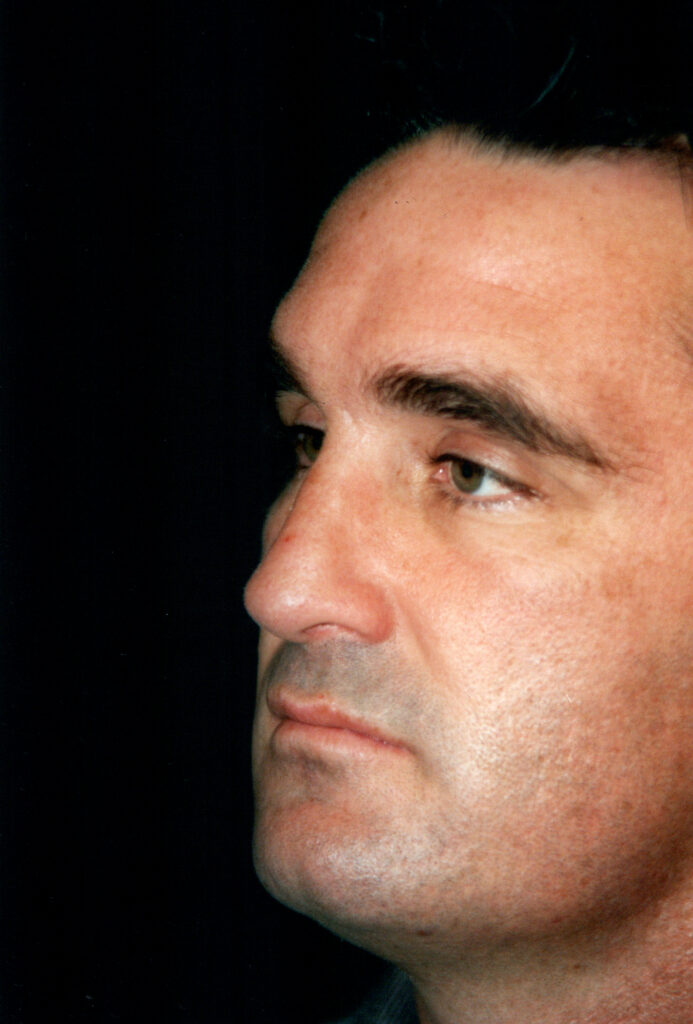 After Image: Rhinoplasty - left-front-oblique
