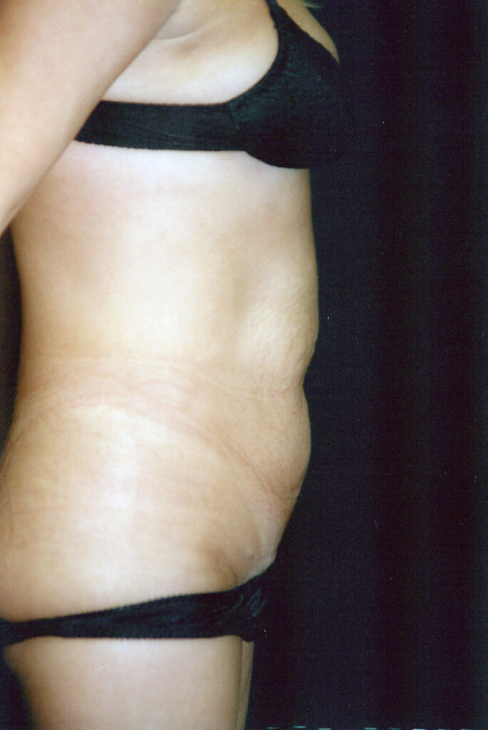 Before Image: Tummy Tuck - right-side