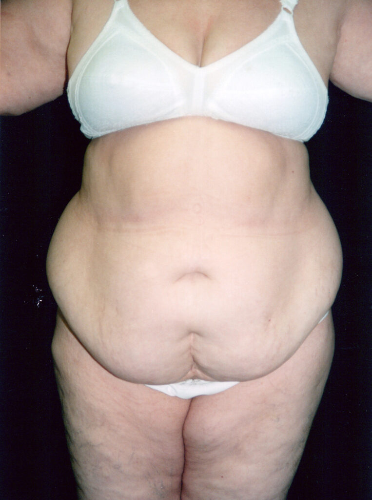 Before Image: Tummy Tuck - front