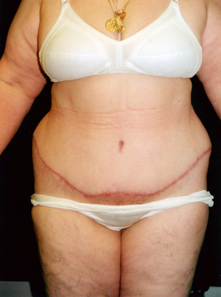 After Image: Tummy Tuck - front