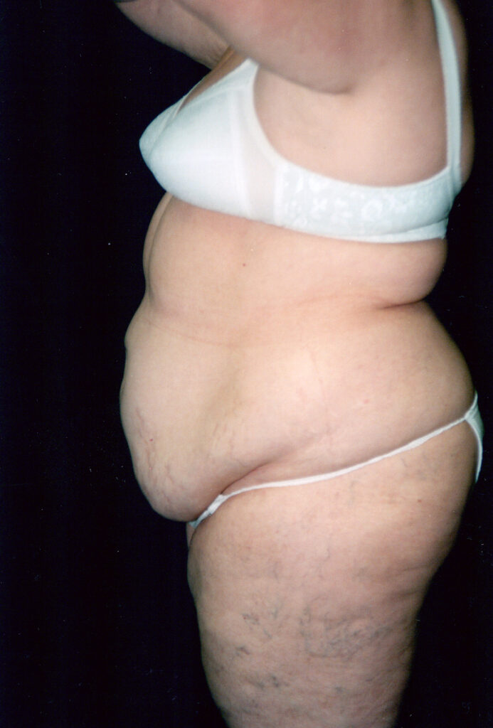 Before Image: Tummy Tuck - left-side
