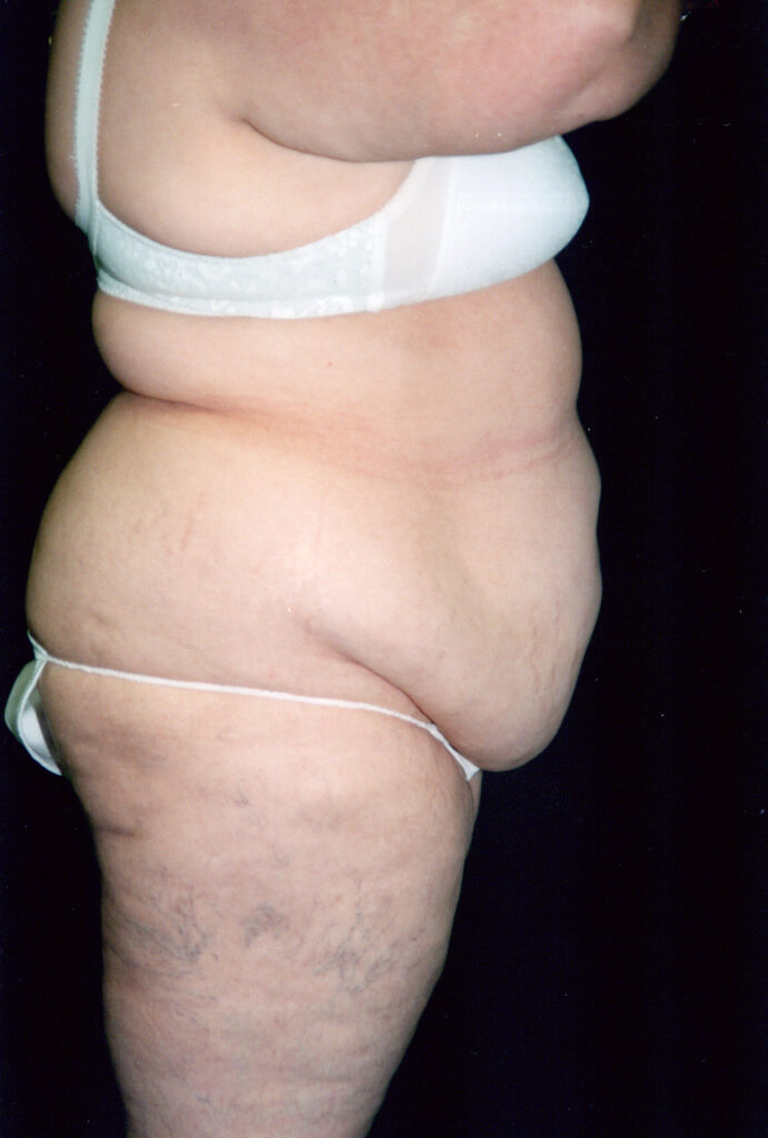 Before Image: Tummy Tuck - right-side