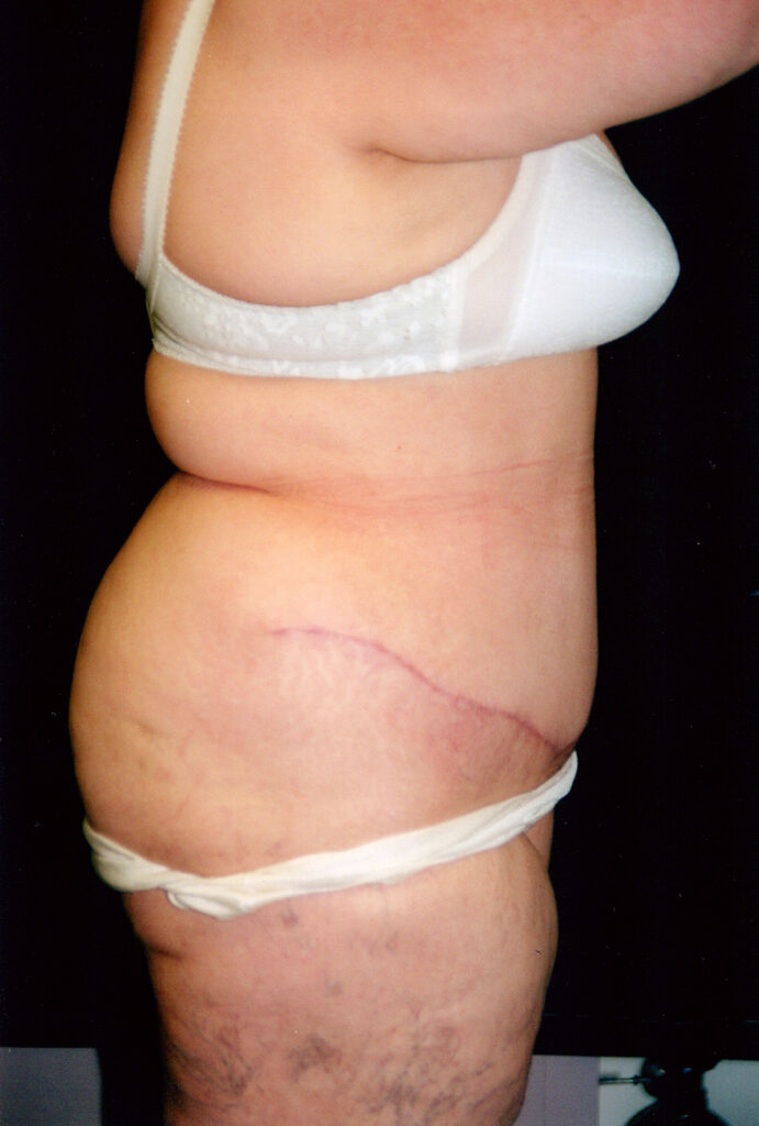 After Image: Tummy Tuck - right-side