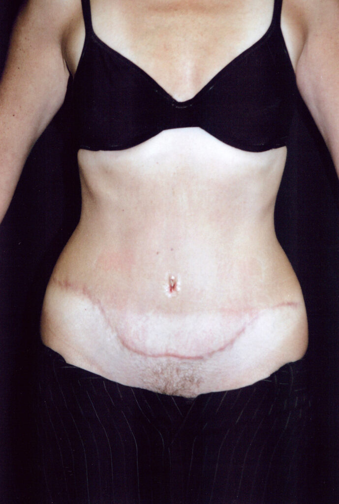 After Image: Tummy Tuck - front