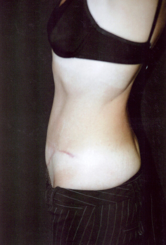 After Image: Tummy Tuck - left-side