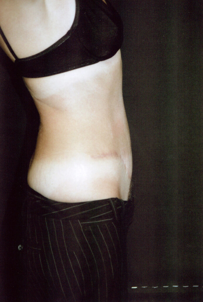 After Image: Tummy Tuck - right-side