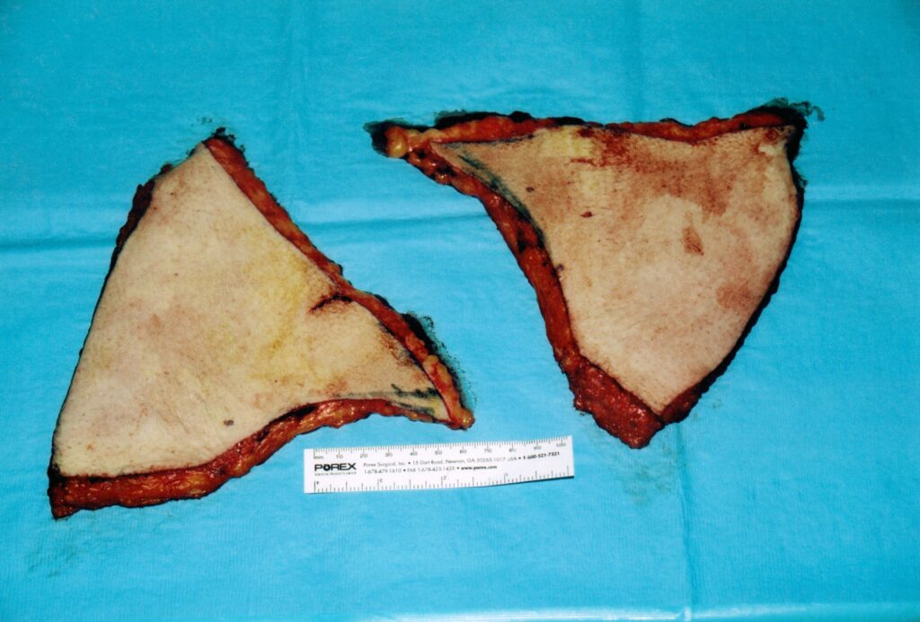 After Image: Tummy Tuck - front