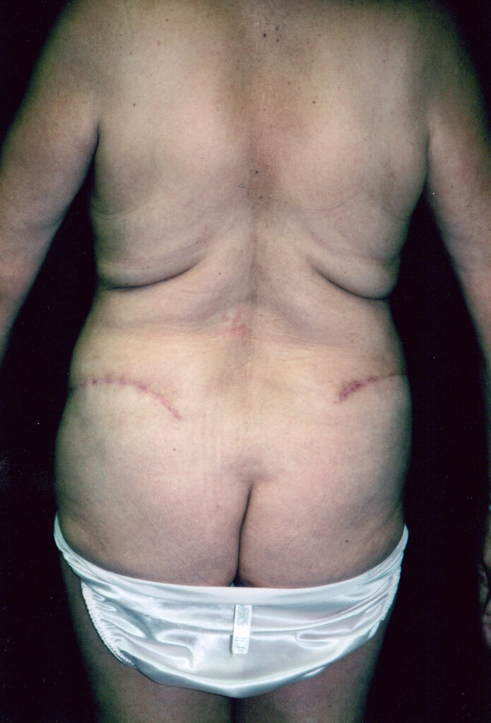After Image: Tummy Tuck - back