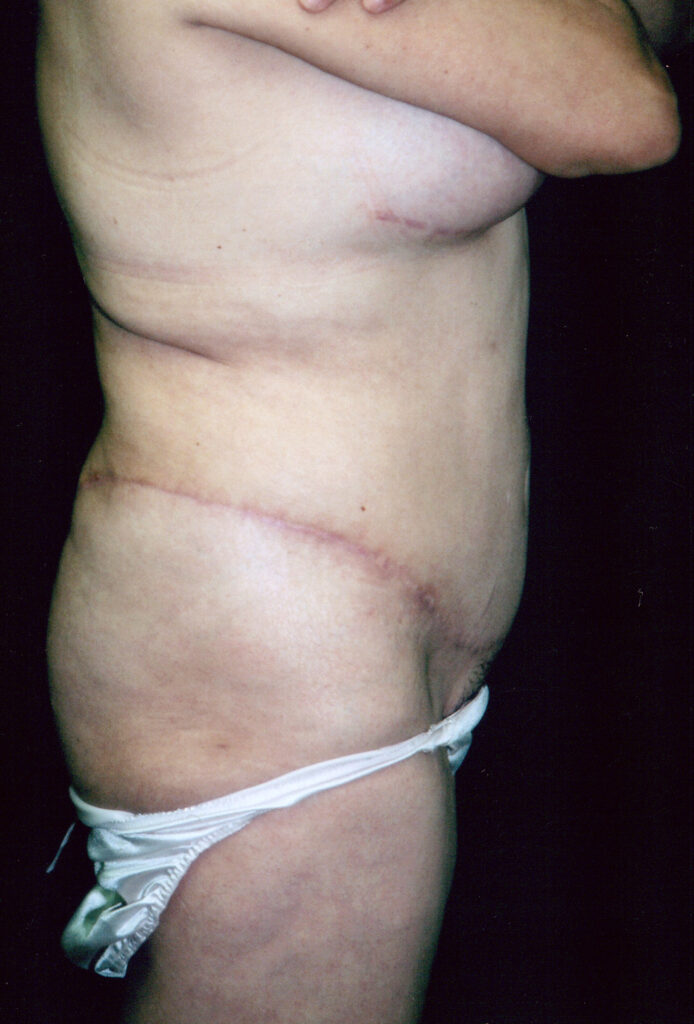 After Image: Tummy Tuck - right-side