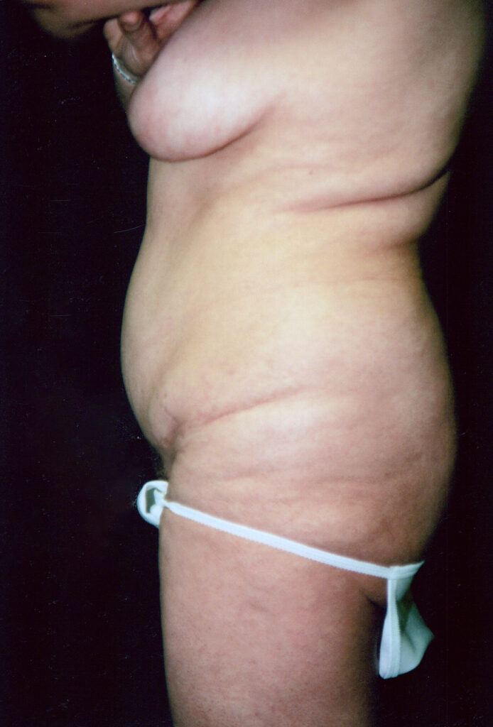 Before Image: Tummy Tuck - left-side