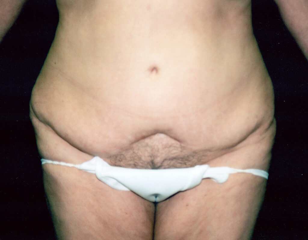 Before Image: Tummy Tuck - front