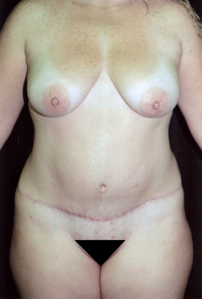 After Image: Tummy Tuck - front