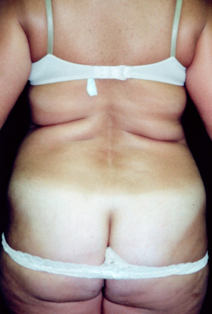 Before Image: Tummy Tuck - back
