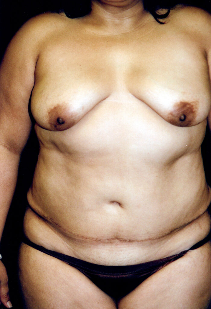 Before Image: Tummy Tuck - front