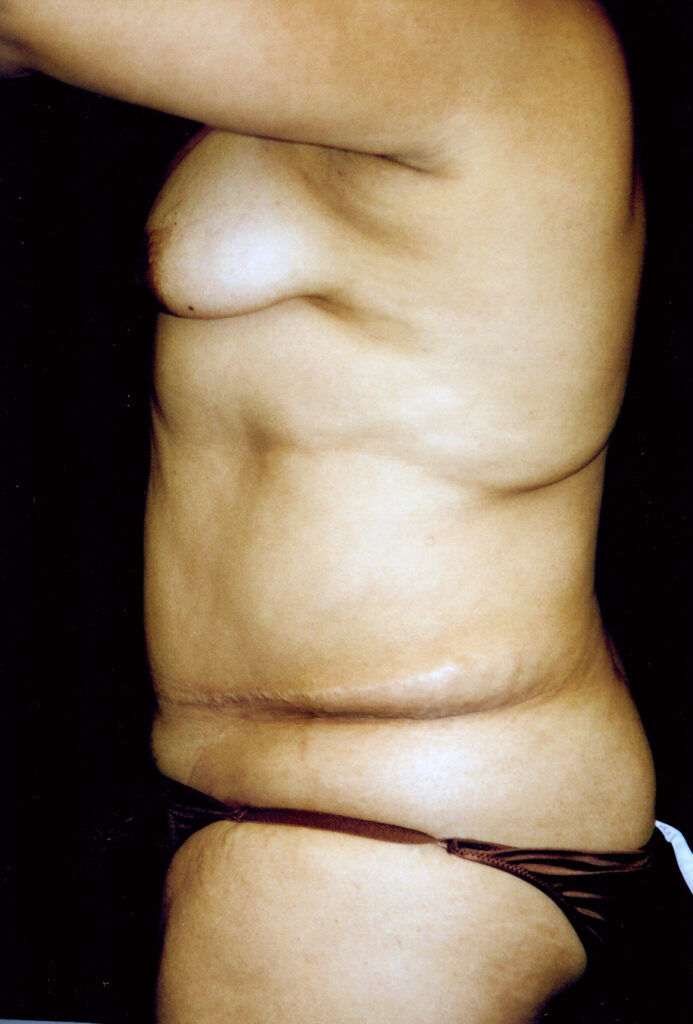 Before Image: Tummy Tuck - left-side