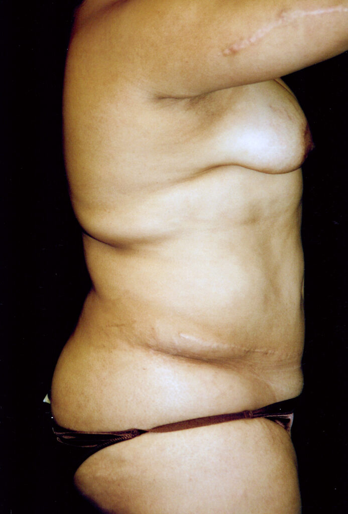 Before Image: Tummy Tuck - right-side