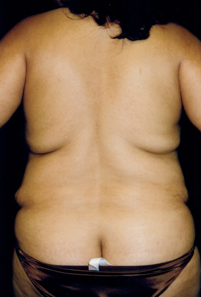 Before Image: Tummy Tuck - back