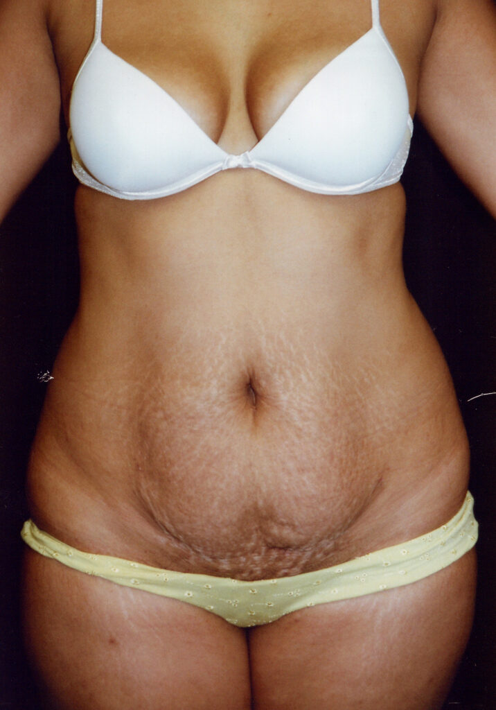 Before Image: Tummy Tuck - front