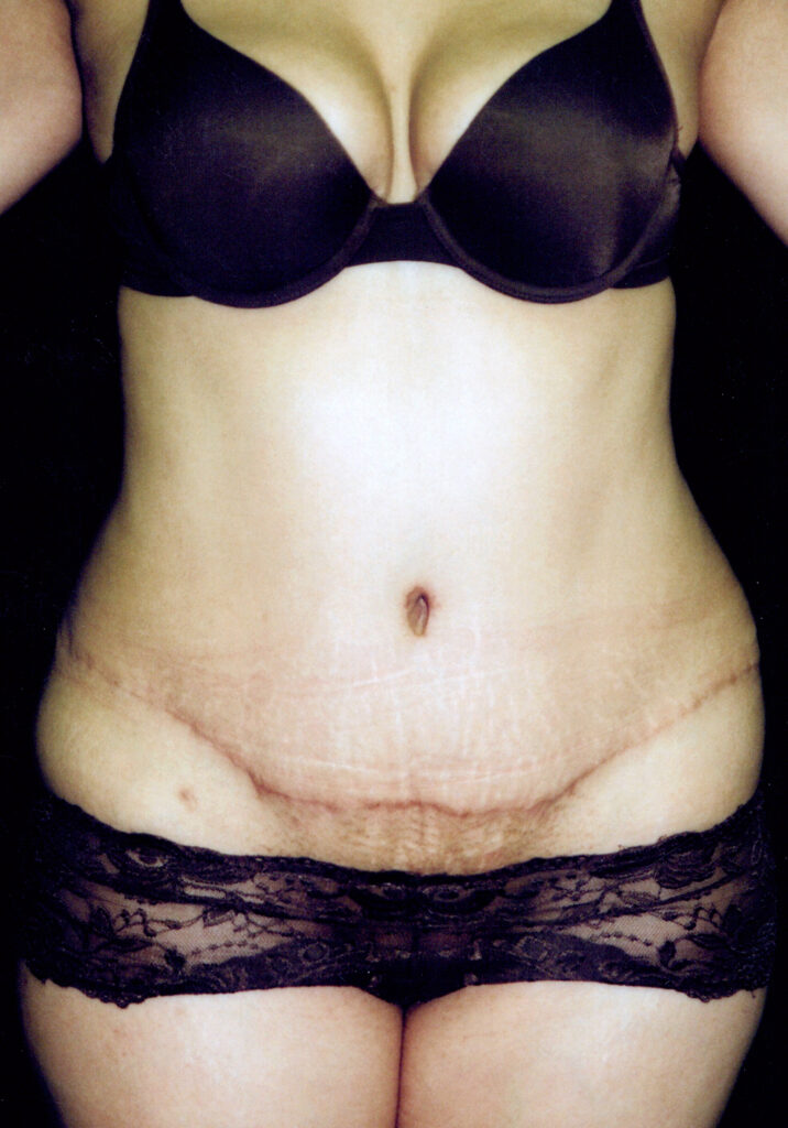 After Image: Tummy Tuck - front