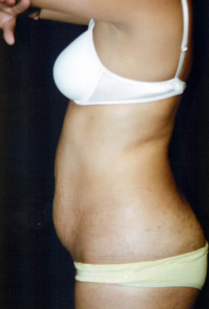 Before Image: Tummy Tuck - left-side