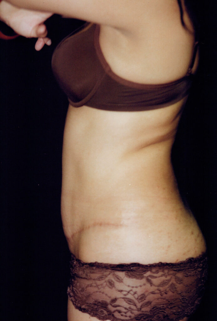 After Image: Tummy Tuck - left-side