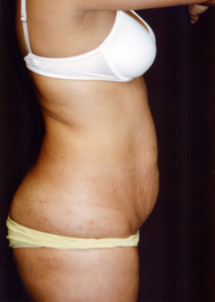 Before Image: Tummy Tuck - right-side