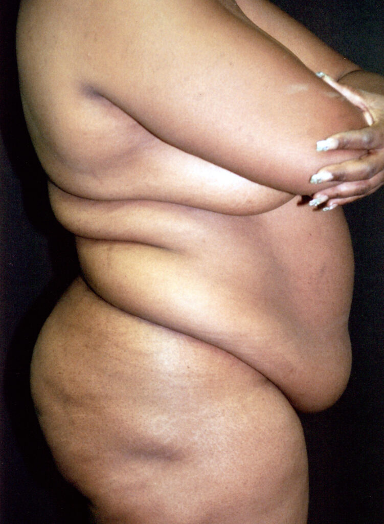 Before Image: Tummy Tuck - right-side
