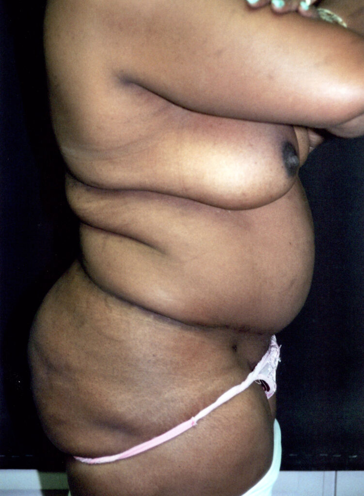 After Image: Tummy Tuck - right-side