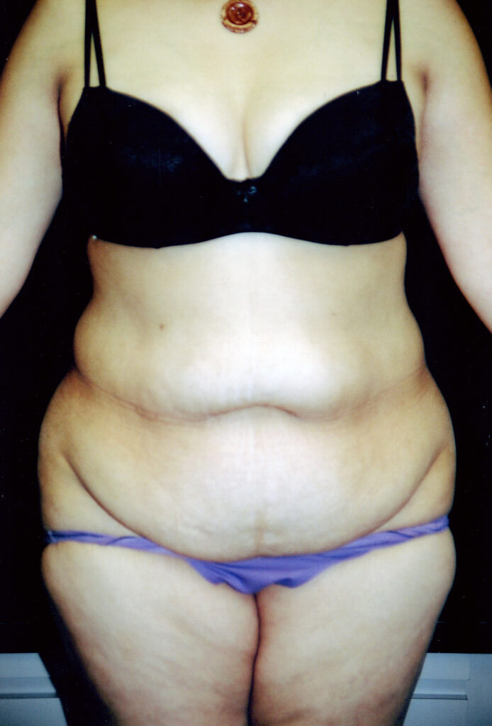 Before Image: Tummy Tuck - front