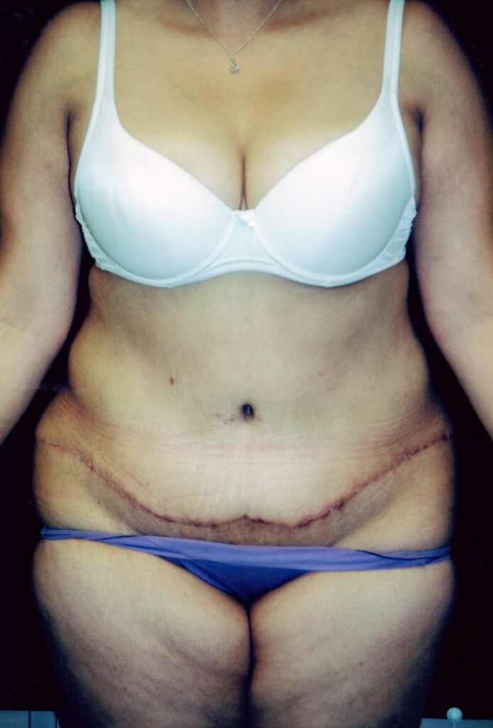 After Image: Tummy Tuck - front