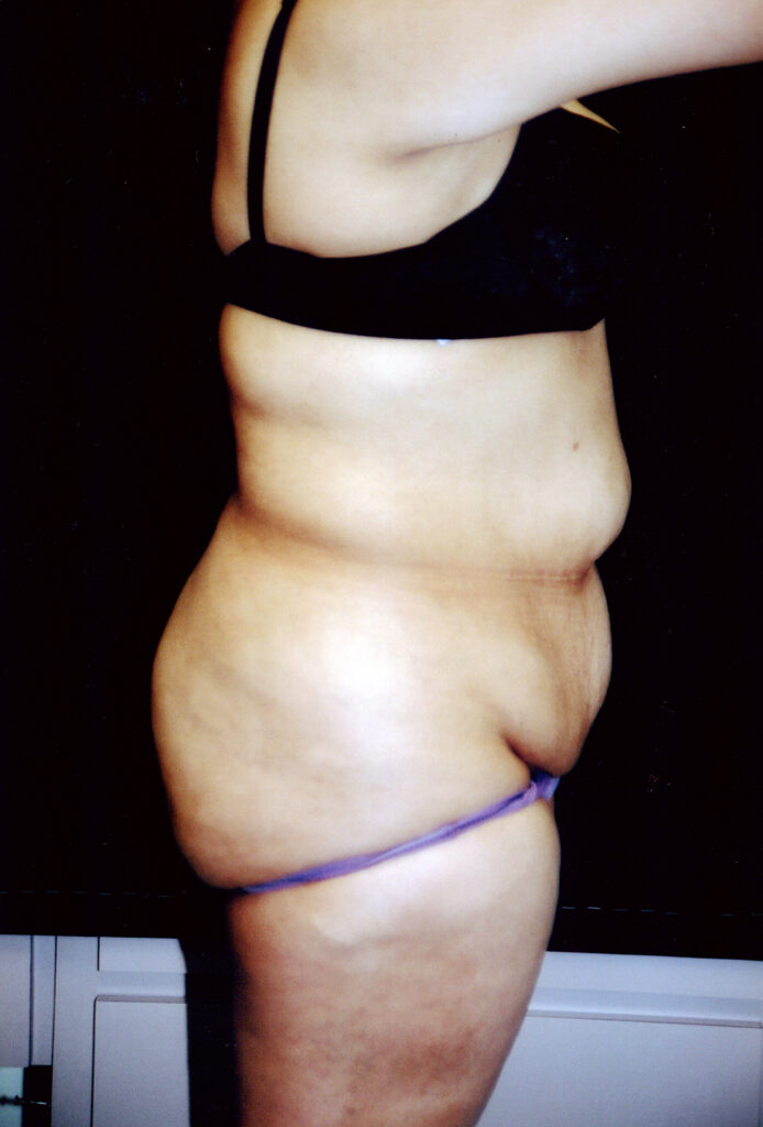 Before Image: Tummy Tuck - right-side
