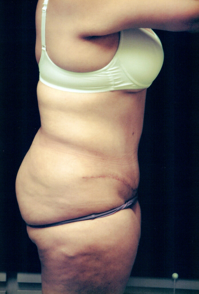 After Image: Tummy Tuck - right-side