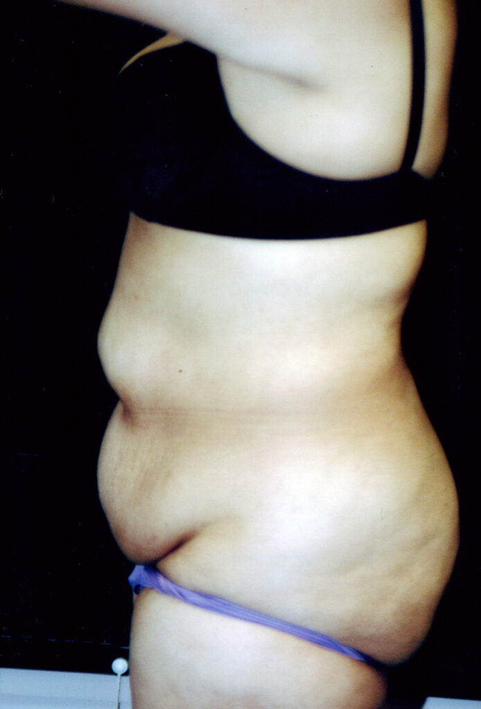 Before Image: Tummy Tuck - left-side