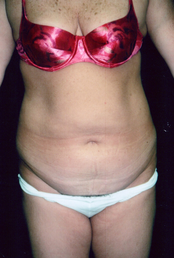 Before Image: Tummy Tuck - front
