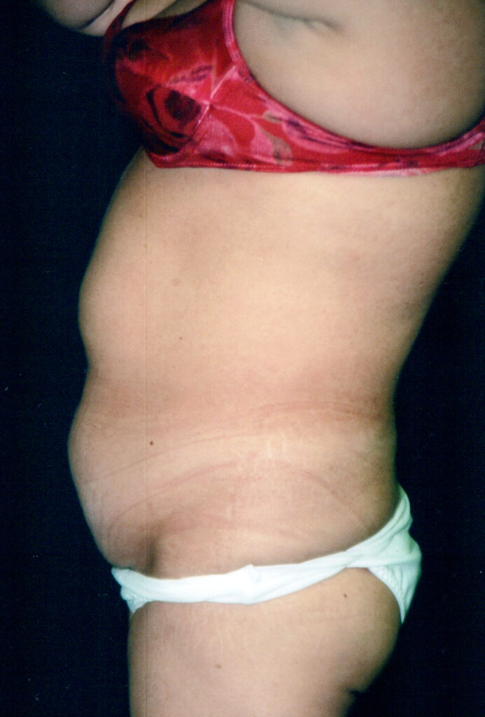 Before Image: Tummy Tuck - left-side