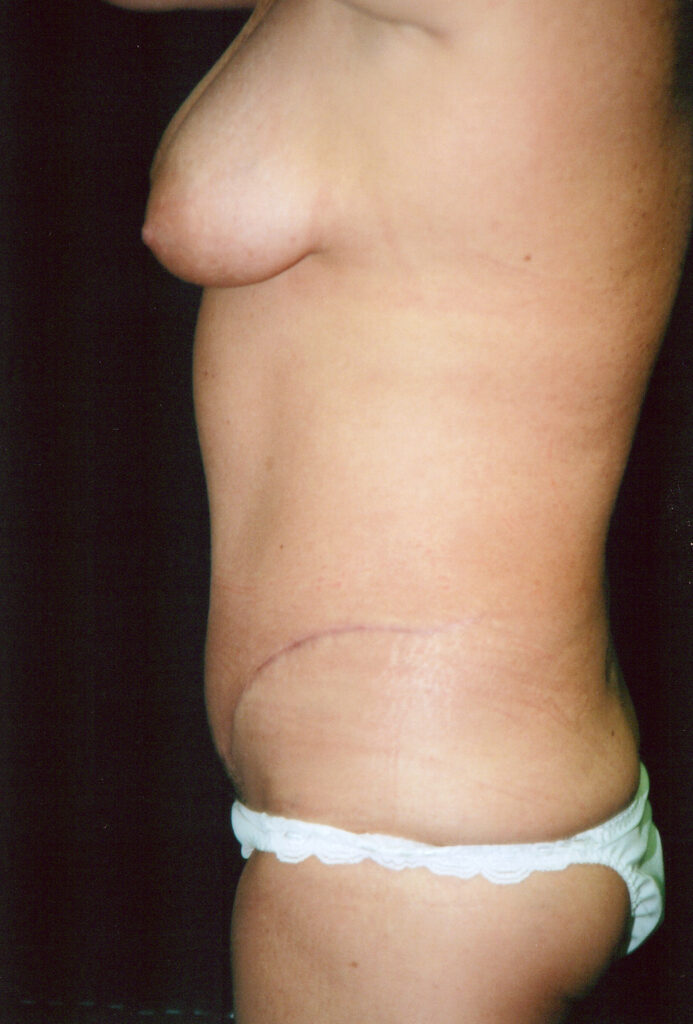 After Image: Tummy Tuck - left-side