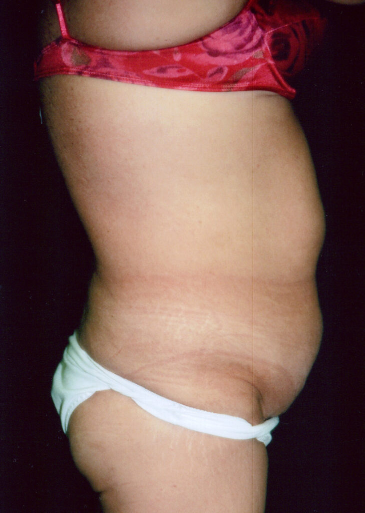 Before Image: Tummy Tuck - right-side