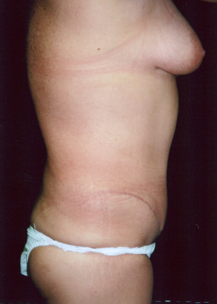After Image: Tummy Tuck - right-side