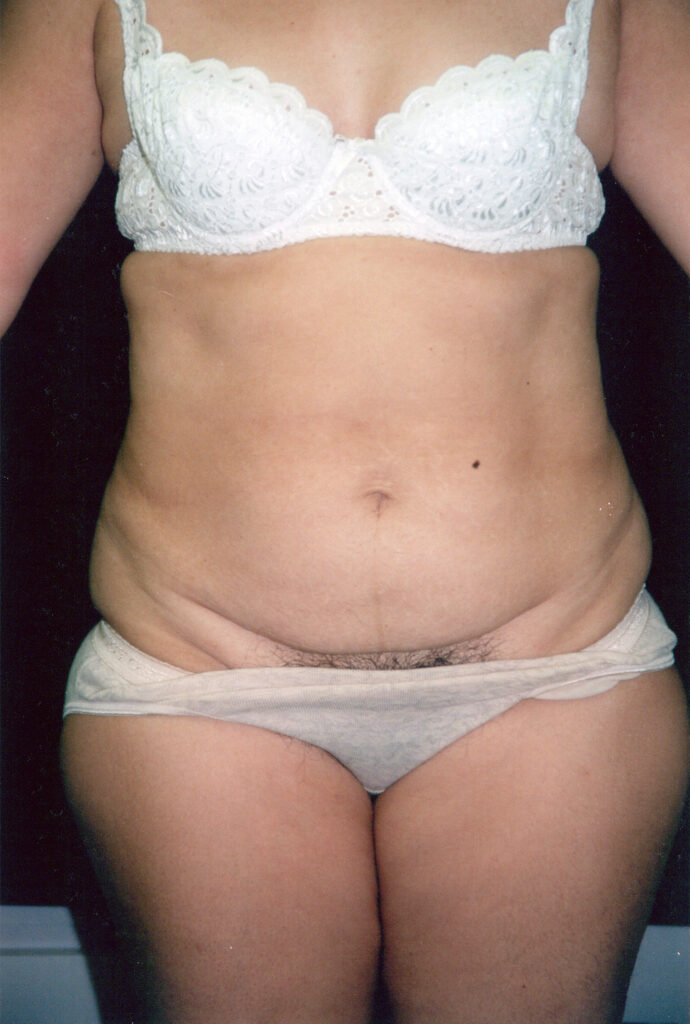 Before Image: Tummy Tuck - front