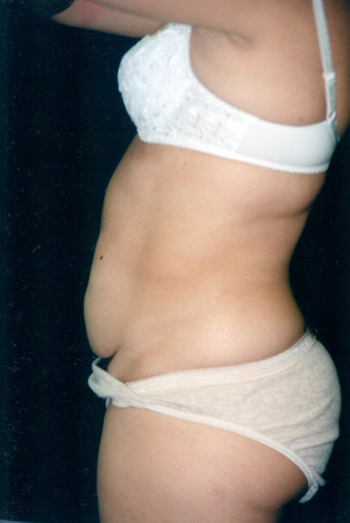 Before Image: Tummy Tuck - left-side
