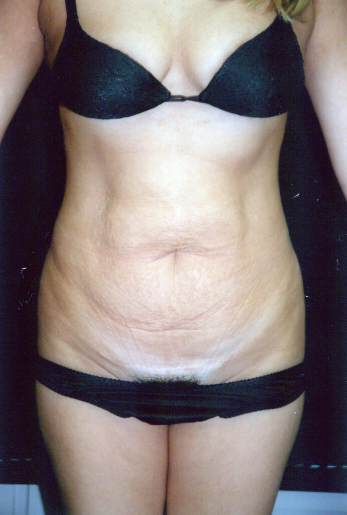 Before Image: Tummy Tuck - front