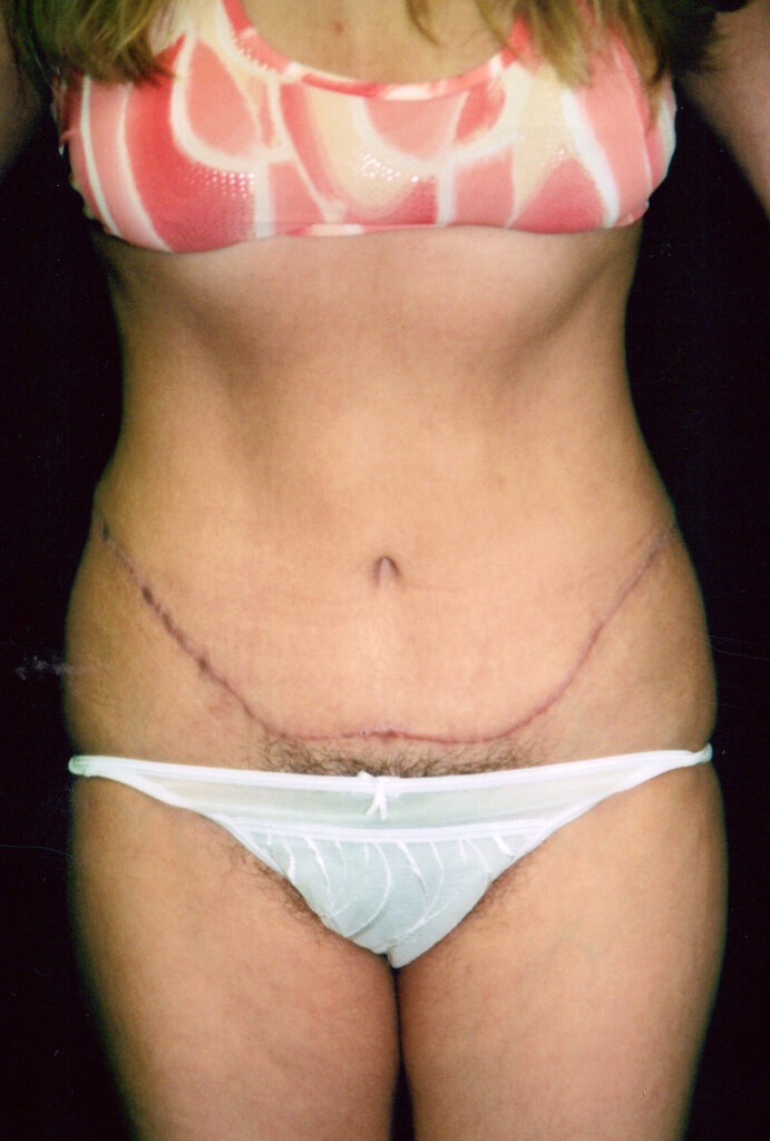 After Image: Tummy Tuck - front
