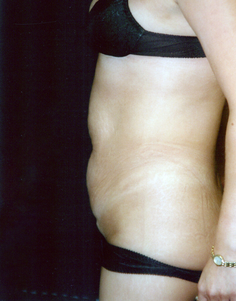 Before Image: Tummy Tuck - left-side